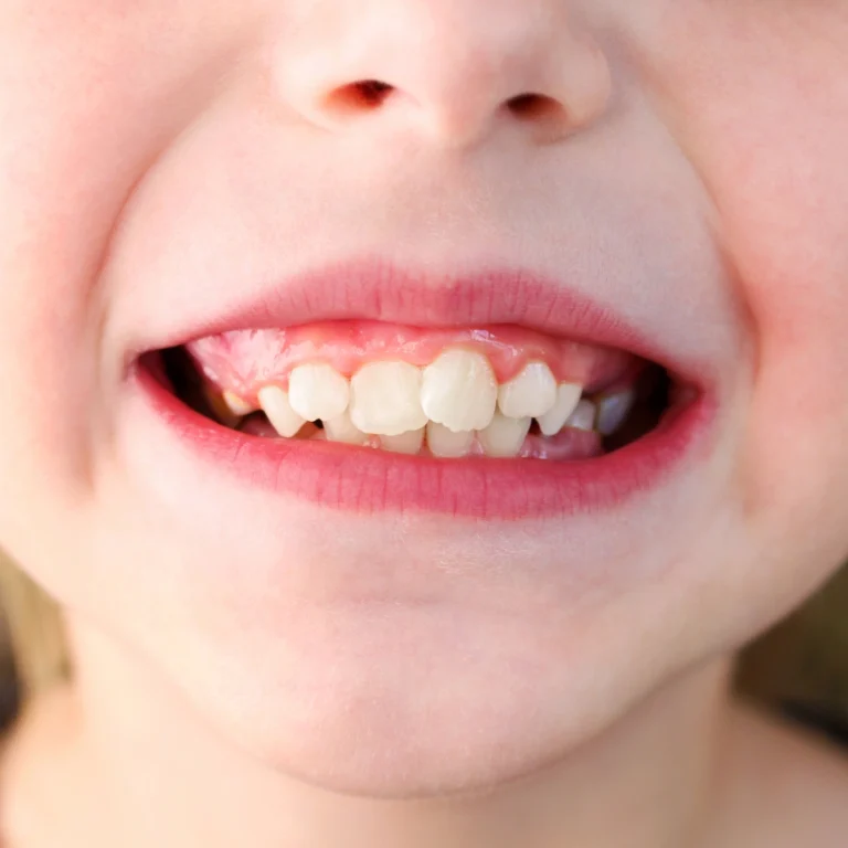 A Respiração Bucal e Seus Efeitos na Dentição